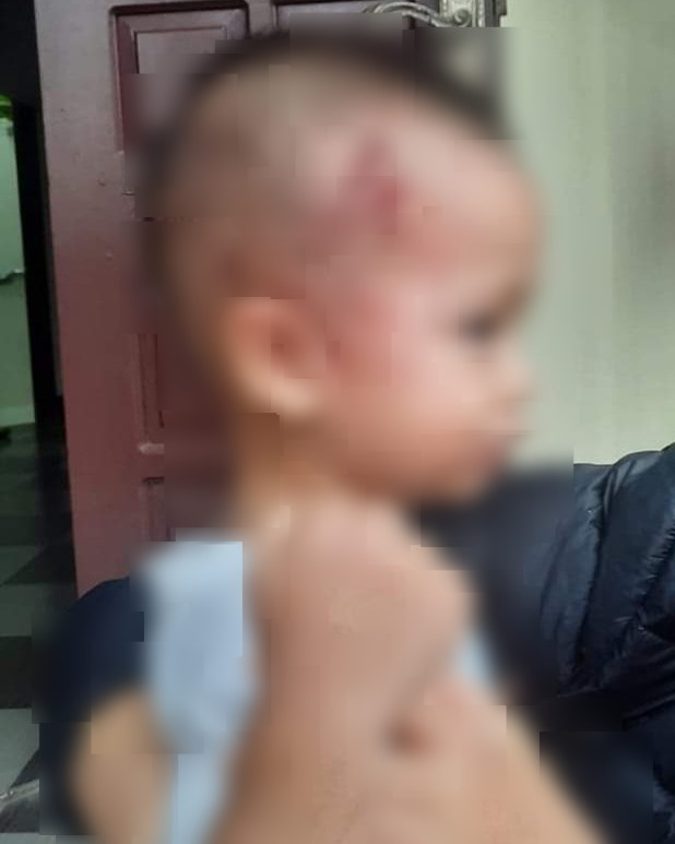 Một trẻ em ở thôn Nam Long, xã Tự Tân bị khỉ hoang tấn công gây xước vùng da đầu, chảy máu. Ảnh: Facebook Trịnh Bá Chuân