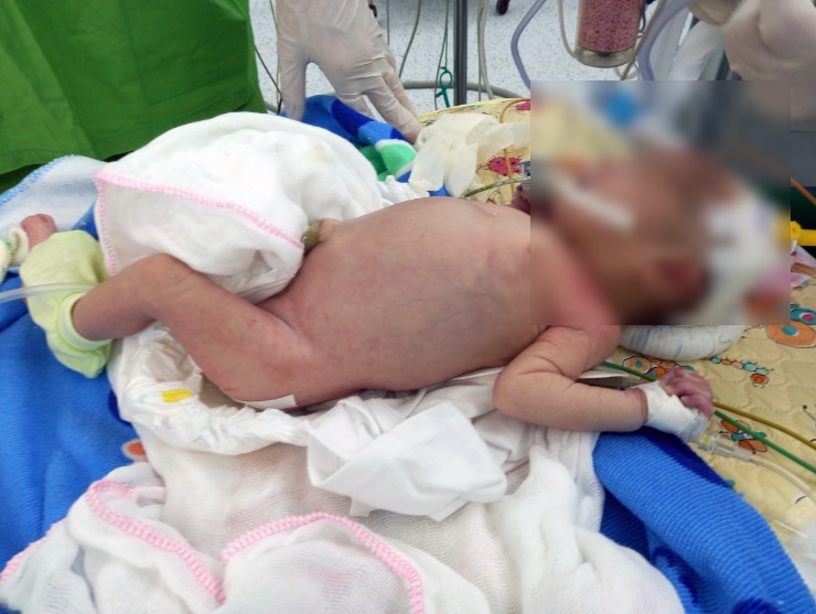 Bé sơ sinh bị hoại tử ruột được Bệnh viện Sản Nhi An Giang cứu sống. Ảnh: BVSNAG
