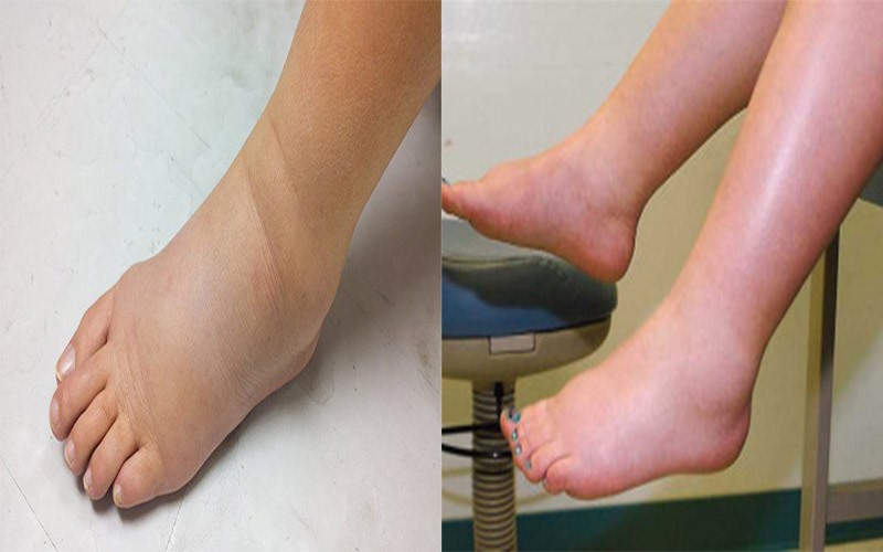 Sưng bàn chân: Một trong những dấu hiệu của căn bệnh suy tim là bàn chân xuất hiện nhiều vết sưng tấy. Khi lưu lượng máu bị ảnh hưởng, nó sẽ dẫn đến tích tụ nước trong các mô. Điều này gây ra phù nề bàn chân, cẳng chân và cả bụng.