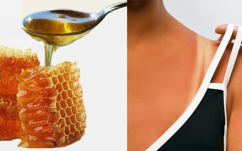 Làm dịu vết cháy nắng: Mật ong là một trong những cách giải quyết vết cháy nắng hiệu quả nhất. Nó có đặc tính làm mềm da, chống viêm và chữa lành vết thương rất tốt. Từ đó, giúp làm dịu da và giảm đau do cháy nắng. Ảnh đồ họa: Gia Linh
