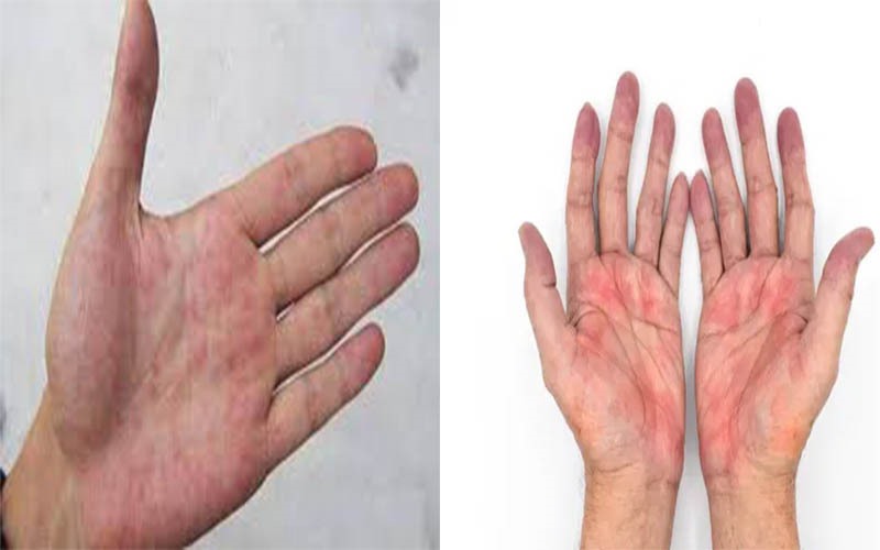 Lòng bàn tay đỏ bất thường: Nếu lòng bàn tay bị xung huyết hoặc xuất hiện các đốm và mảng màu đỏ thì đó là biểu hiện của bệnh gan. Đây là dấu hiệu quan trọng thường gặp của bệnh viêm gan và xơ gan.