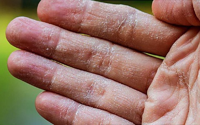 Gây khô da: Vào mùa đông, tắm nước nóng có thể khiến da bị khô do lấy đi độ ẩm trên da. Ngoài ra, nếu bạn có làn da nhạy cảm, tốt hơn là không nên tắm bằng nước nóng vì nó có thể gây phát ban và các bệnh dị ứng khác.