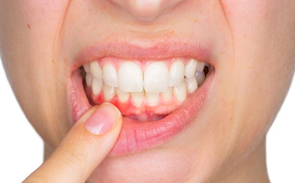 1.Bệnh nướu răng: Bệnh nha chu hay còn gọi là bệnh nướu răng xảy ra khi mảng bám tích tụ trên răng gây ra tình trạng viêm nướu. Tình trạng viêm có thể khiến nướu xung quanh răng của bạn bị đỏ, sưng và mềm. Bạn có thể nhầm lẫn tình trạng này với đau răng, cuối cùng có thể khiến răng bị đau hoặc lung lay.