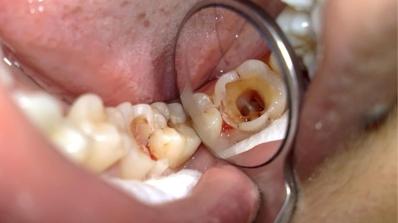 4. Sâu răng: Sâu răng là một nguyên nhân phổ biến khác khiến răng đau khi thức dậy. Sâu răng là do vi khuẩn ăn mòn men răng và ngà răng của bạn. Điều này kích thích dây thần kinh răng dẫn đến cơn đau. Ngoài ra, vi khuẩn có thể xâm nhập vào răng và gây nhiễm trùng tủy răng. Vì vậy, nên trám răng sâu càng sớm càng tốt.