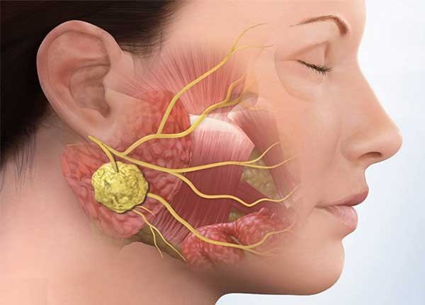 U thần kinh thính giác là những khối u nằm trong dây thần kinh của tai, dẫn đến mất thính lực hoặc một số tiếng ồn giống như tiếng còi trong tai (ù tai).