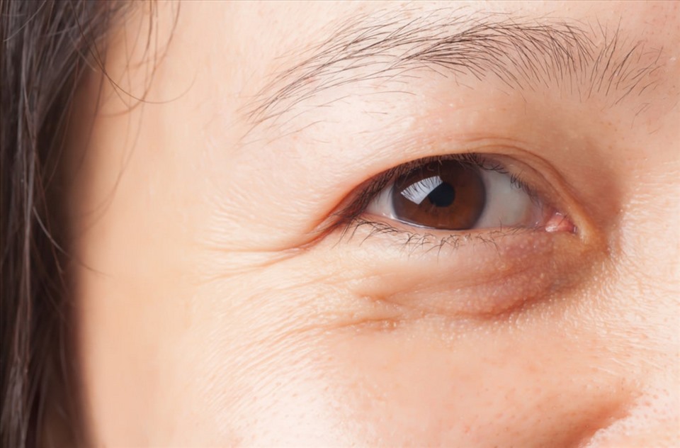 Nếp nhăn vùng mắt thường khiến nhiều chị em cảm thấy buồn phiền. Ảnh: Xinhua