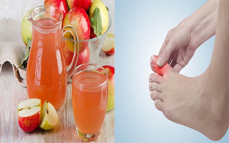 Nước ép táo: Nước ép táo trung hòa axit trong cơ thể, từ đó giúp giảm đau và viêm. Táo cũng chứa axit malic, có tác dụng làm giảm nồng độ axit uric trong cơ thể. Uống một cốc nước ép táo mỗi ngày để ngăn ngừa và làm giảm các triệu chứng của bệnh gout.