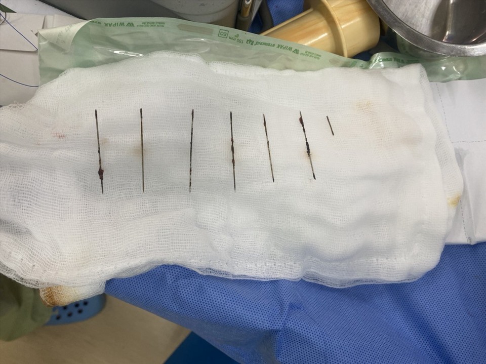 7 cái kim được lấy ra từ trong người bệnh nhân.