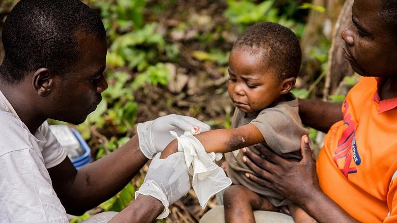 Một trẻ bị bệnh đậu mùa khỉ được điều trị tại một trung tâm của tổ chức phi chính phủ Bác sĩ không biên giới, ở Zomea Kaka, Cộng hòa Trung Phi, năm 2018. Ảnh: AFP