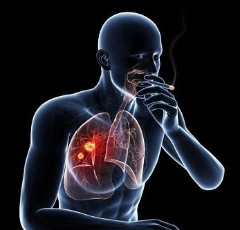 Hút thuốc lá gây ung thư phổi là điều hầu hết người Việt đều biết nhưng vẫn mắc phải. Ảnh: ST