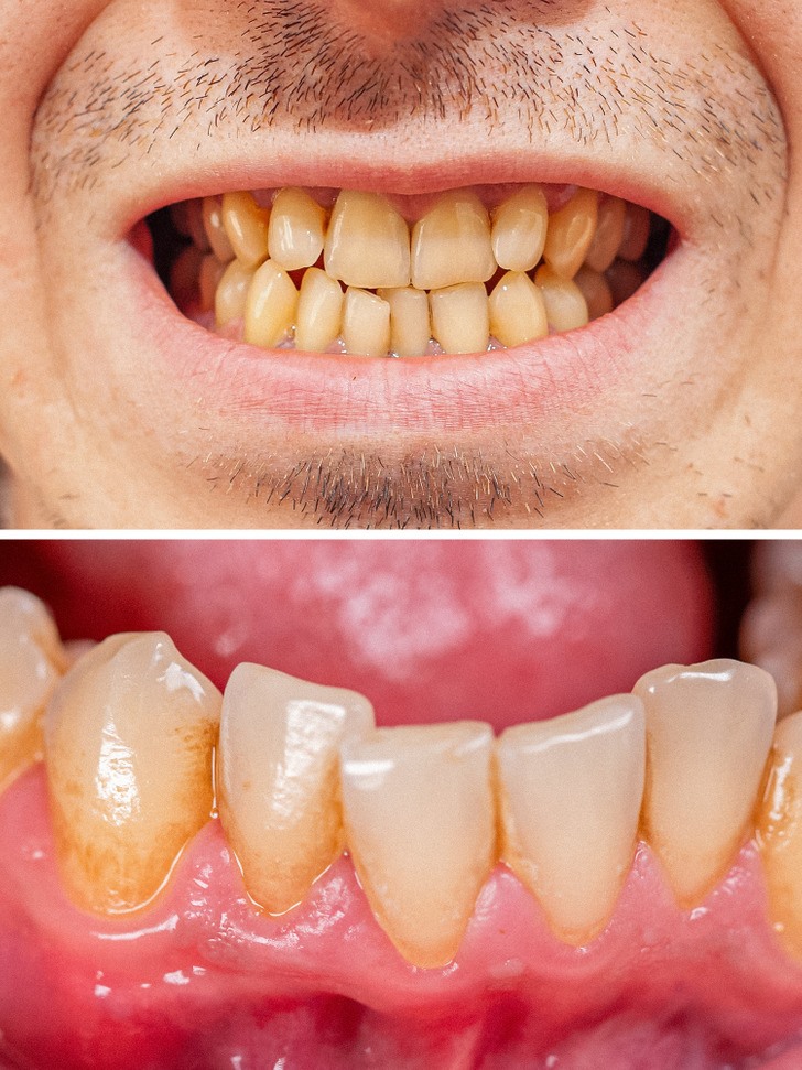 Các nha sĩ khuyên rằng, chúng ta chỉ nên đánh răng 2 ngày 1 lần để giữ răng thật sạch sẽ. Không nên đánh răng nhiêu hơn 2 lần bởi nếu chải quá thường xuyên, men răng của chúng ta có thể bị mòn và gây ra răng nhạy cảm. (Ảnh: Brightside)