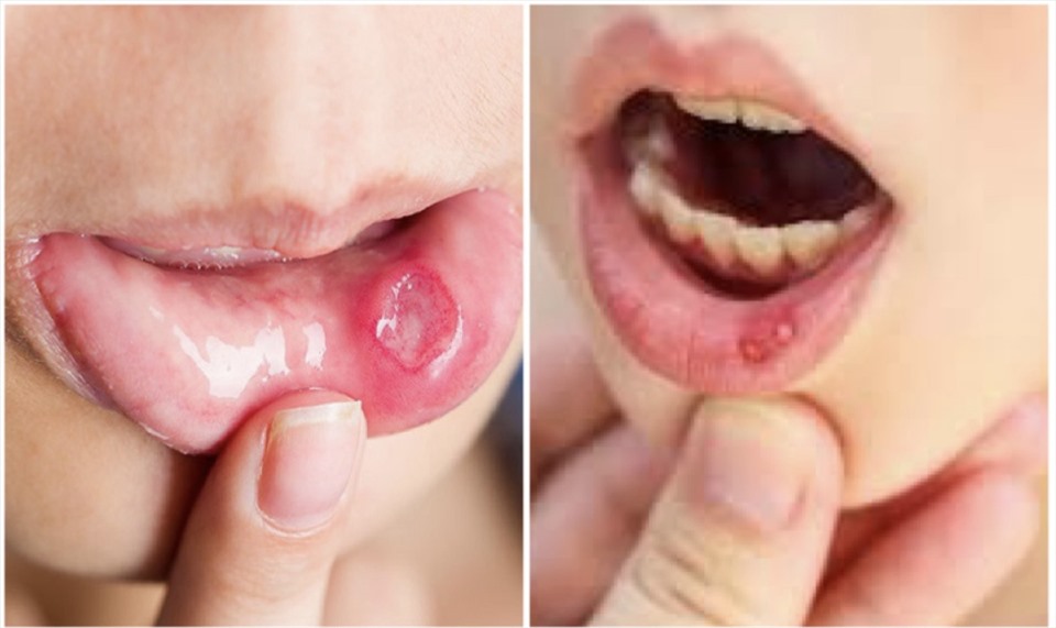 4. Lở miệng Đau nhức bên trong miệng có thể do thay đổi nội tiết tố hoặc căng thẳng cảm xúc. Ngoài ra, nó cũng có thể chạy trong gia đình, vì vậy bạn có thể dễ dàng sử dụng nó. Thiếu vitamin B-12 là một nguyên nhân khác có thể làm xuất hiện vết loét.