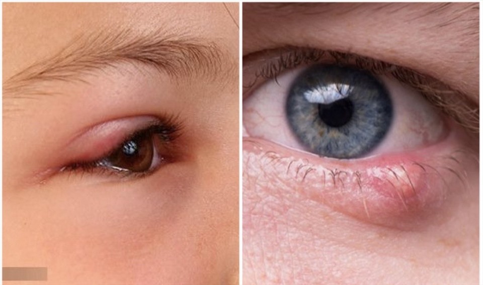 5. Mụn mí mắt Mụn nhỏ trên mí mắt của bạn được gọi là mụn lẹo . Chúng thường mọc rất gần lông mi và khiến bạn khó chớp mắt, đồng thời có thể gây ngứa. Chúng thường xuất hiện trên da nếu bạn bị tiểu đường hoặc da quá khô . Nó cũng có thể là một dấu hiệu cho thấy bạn cần thay đổi danh bạ hoặc cọ trang điểm.