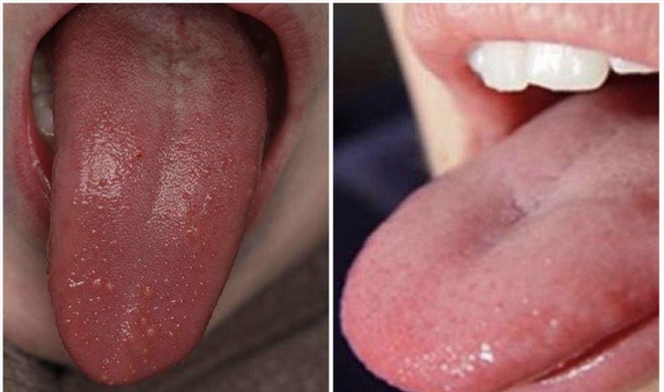 7. Lưỡi sậm màu Lưỡi đỏ không chỉ là dấu hiệu của  nhiễm trùng mà còn là mụn trứng cá và thiếu vitamin. Một nguyên nhân khác có thể là  ban đỏ , có thể làm cho lưỡi của bạn nhợt nhạt nhưng có những chấm đỏ tươi. Bên cạnh đó, mụn rộp miệng cũng có thể dẫn đến lưỡi có màu sáng.