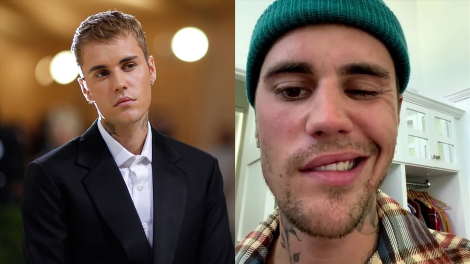 Justin Bieber bị liệt nửa mặt do một căn bệnh hiếm gặp. Ảnh: Instagram.
