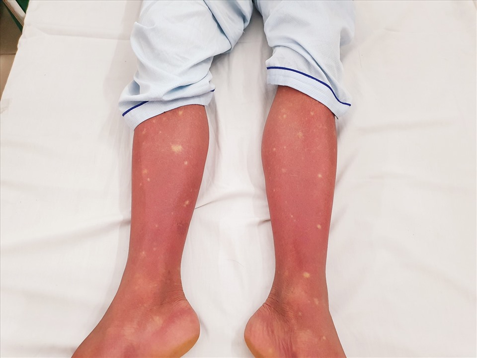 Hình ảnh xuất huyết trên chân của bệnh nhân sốt xuất huyết. Ảnh: BVCC