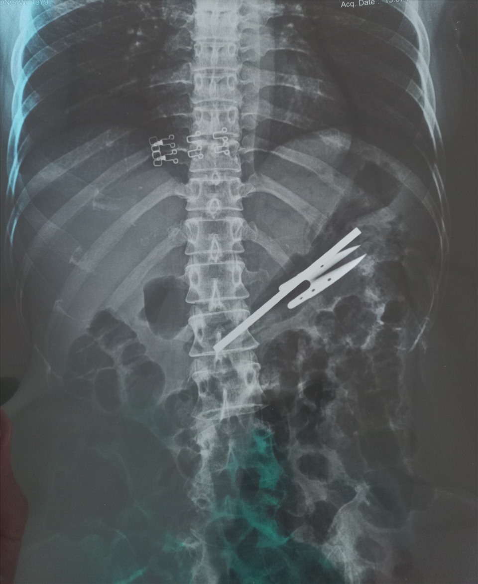 Qua chụp X-Quang phát hiện trong dạ dày bệnh nhân có dị vật. Ảnh: Hà Anh Chiến
