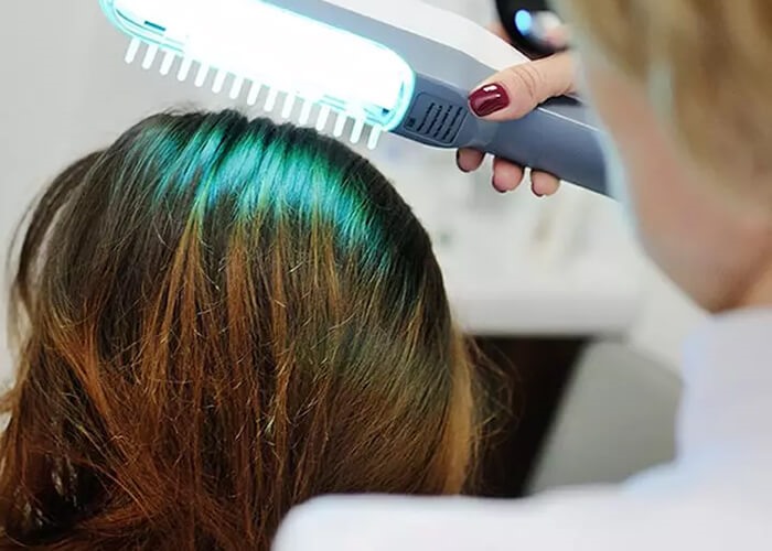 Điều trị hói tóc bằng laser. Ảnh: Goldwell