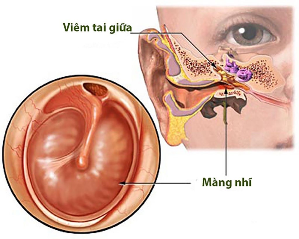 Viêm tai giữa rất dễ gây thủng màng nhĩ.