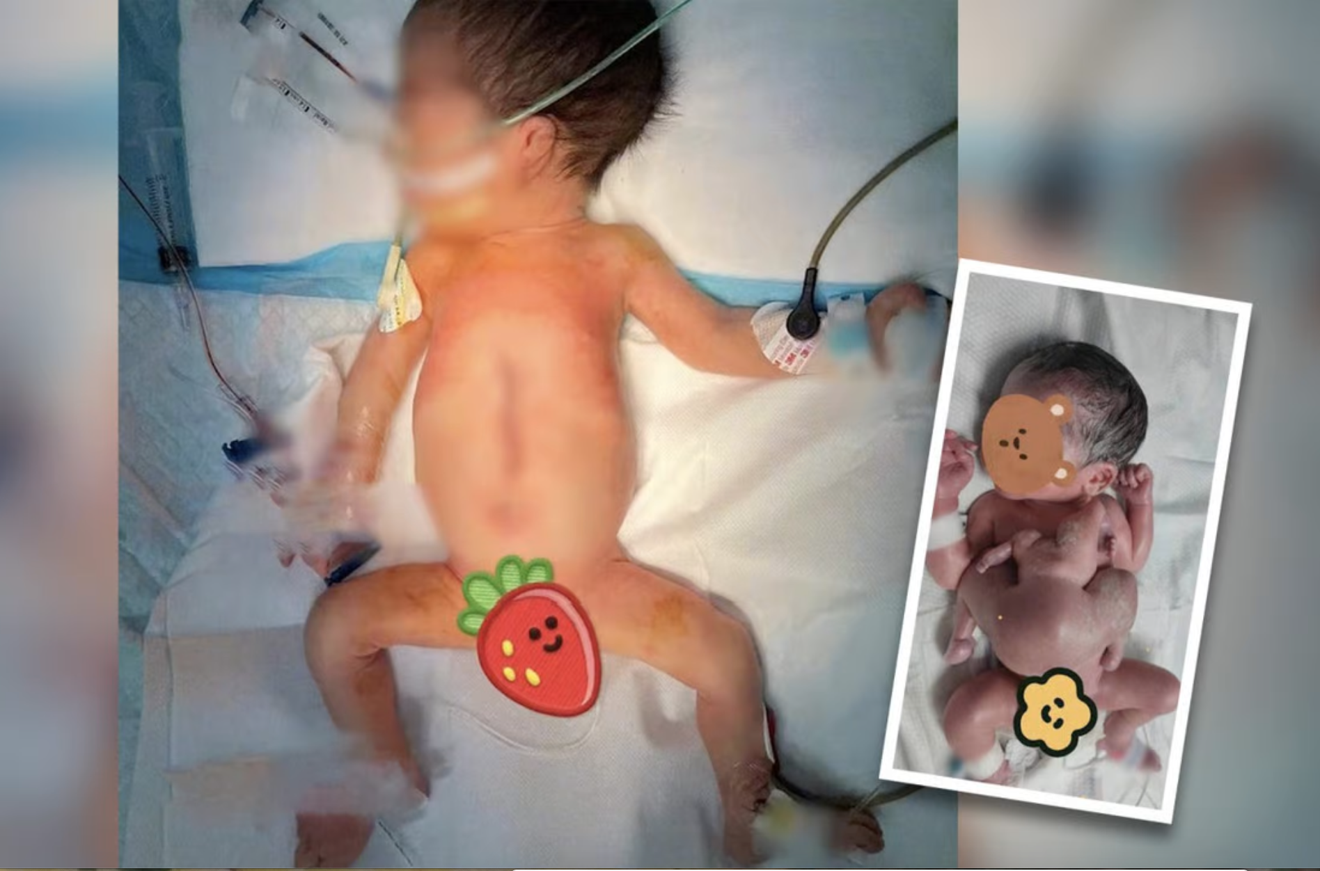 Em bé ở Trung Quốc bị một bào thai dị tật hiếm gặp kí sinh. Ảnh chụp màn hình.