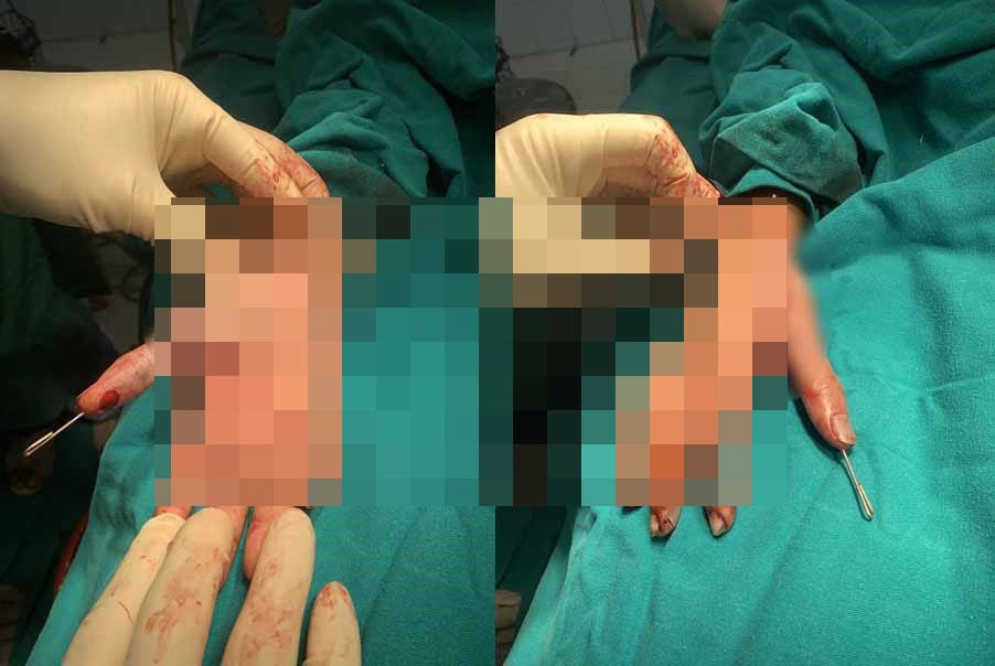 Bàn tay sau khi được các bác sĩ phẫu thuật. Ảnh: H.H