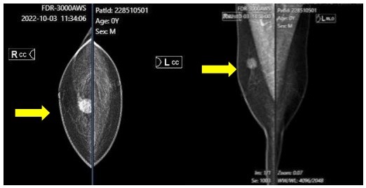 Hình ảnh chụp XQuang phát hiện khối u ở bệnh nhân. Ảnh: BVCC