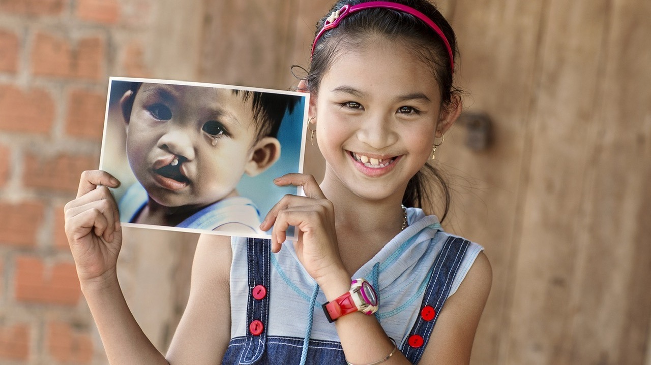 Những chương trình thiện nguyện của các nhà hảo tâm, các tổ chức và doanh nghiệp trở thành niềm hy vọng rất lớn cho trẻ em bị hở môi, hàm ếch bẩm sinh.