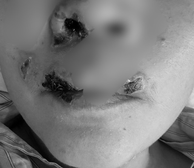 Hình ảnh bệnh nhân nhiễm liên cầu lợn điều trị tại Bệnh viện Bệnh Nhiệt đới Trung ương. Nguồn ảnh: Bệnh viện Bệnh Nhiệt đới TW