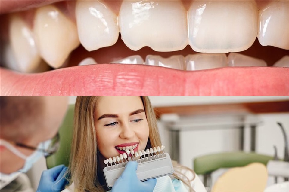 Có nhiều nguyên nhân khiến răng bị sứt mẻ. Đồ họa: Thu Trang