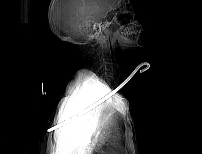 Hình ảnh chụp CT - Scan cho thấy thanh sắt xuyên qua cổ ông Đ ra sau lưng. Ảnh: Tuấn Dũng.
