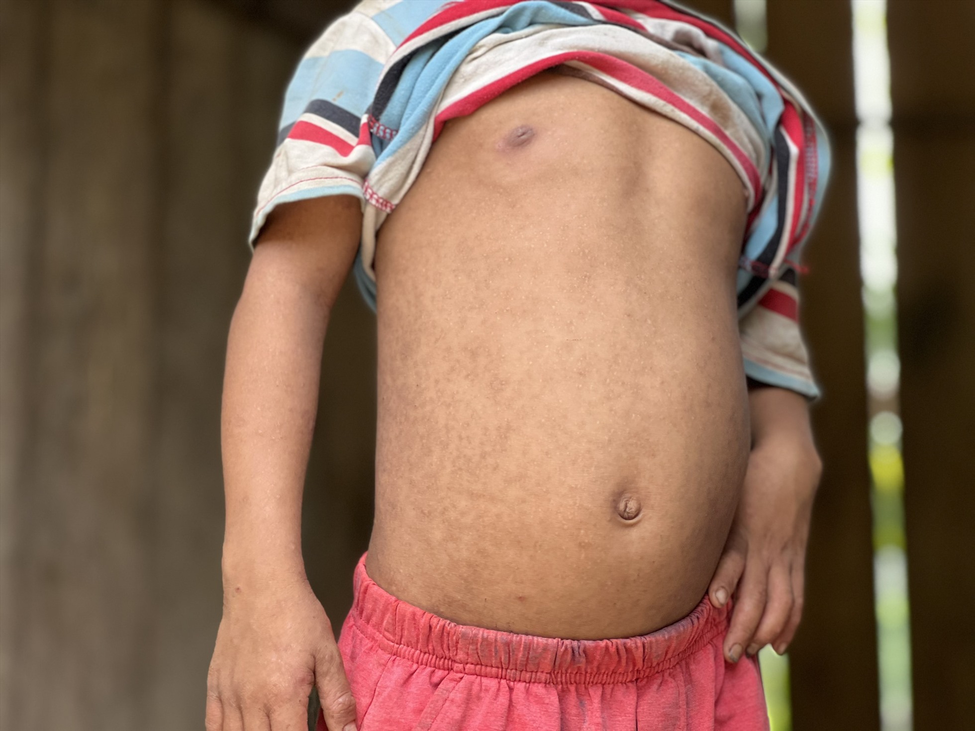 Con trai anh Hồ Văn Đậu ở thôn Tang với cơ thể đầy vết tích của bệnh ghẻ. Ảnh: Ngọc Viên
