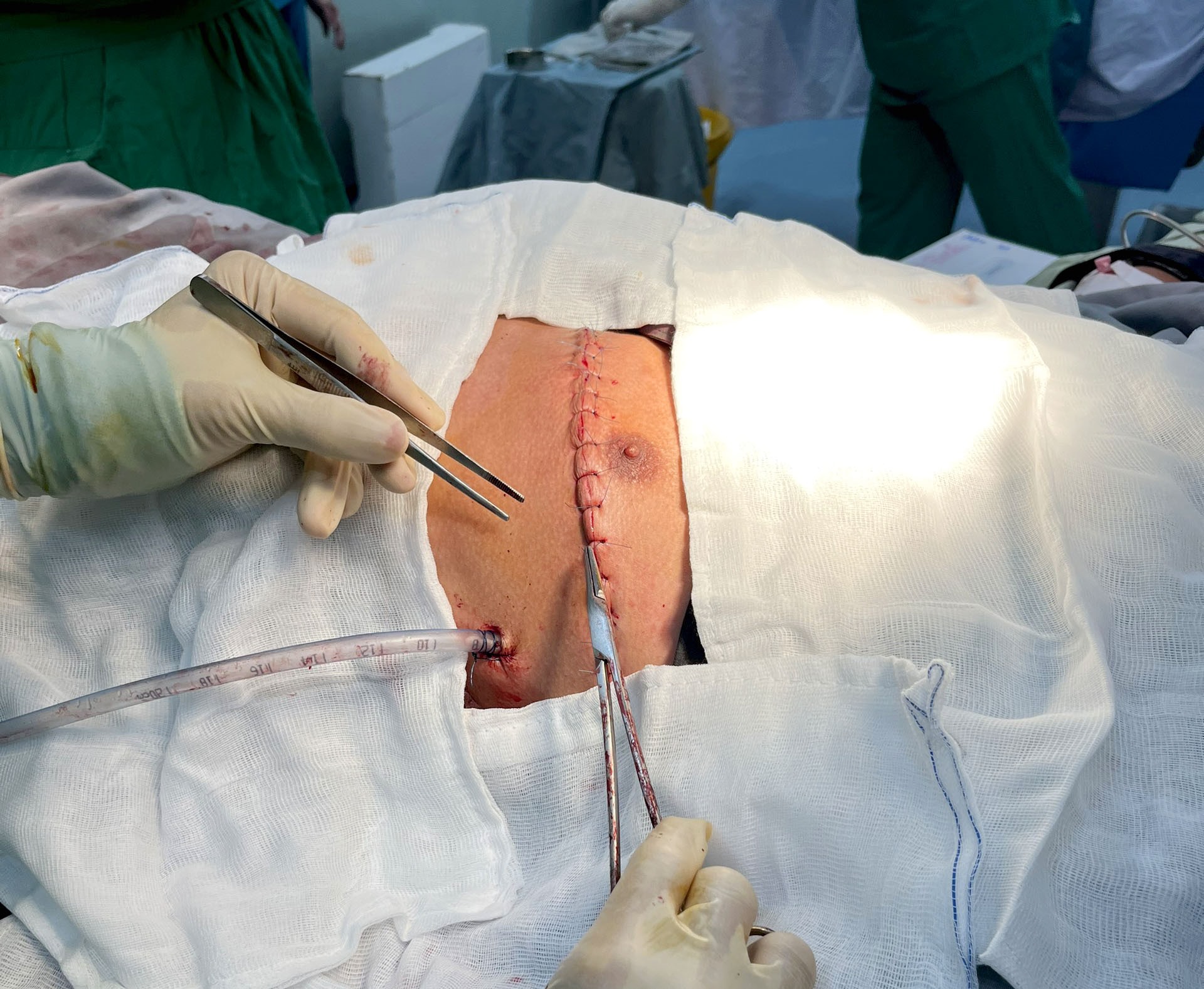 Ê kíp thầy thuốc đã cấp cứu, phẫu thuật và gây mê hồi sức thành công, cứu sống bệnh nhân Trần Văn Ph, bị thanh kim loại đâm vào tim. Ảnh: Bệnh viện cung cấp.