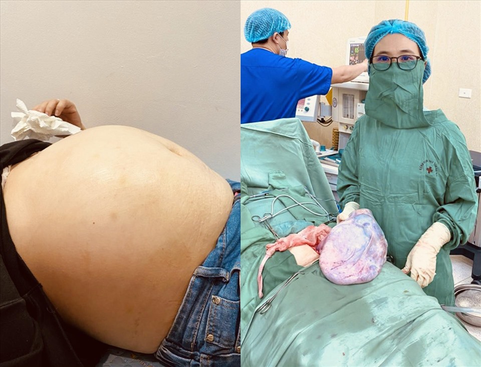 Khối u khổng lồ trong tử cung của người phụ nữ. Nguồn ảnh: Bệnh viện Phụ sản Hà Nội
