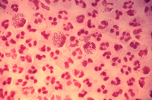 Vi khuẩn bệnh lậu, một bệnh lây truyền qua đường tình dục. Nguồn ảnh: Bệnh viện Phụ sản Hà Nội