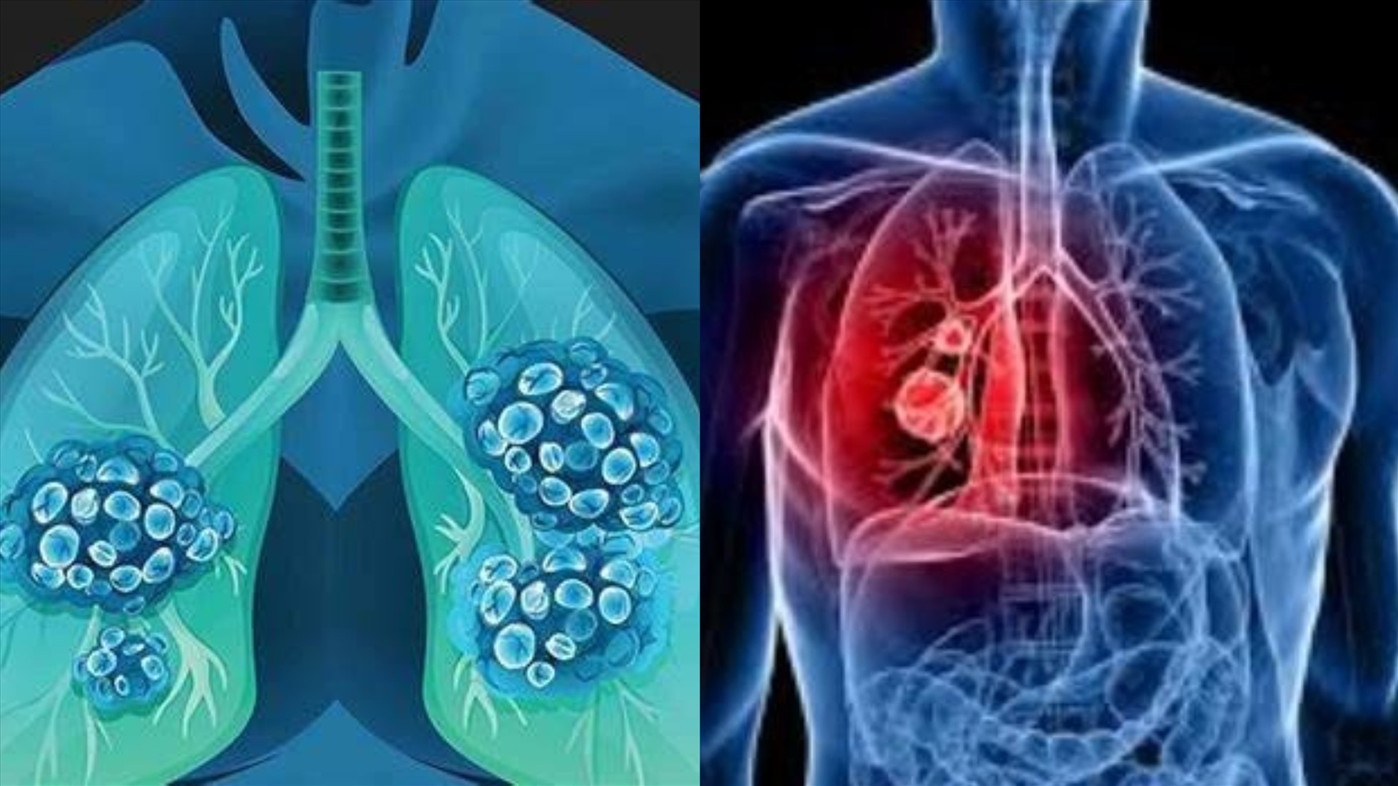 Phát hiện ung thư phổi sớm sẽ điều trị kịp thời và kéo dài sự sống. Ảnh đồ họa: Tuệ Nhi