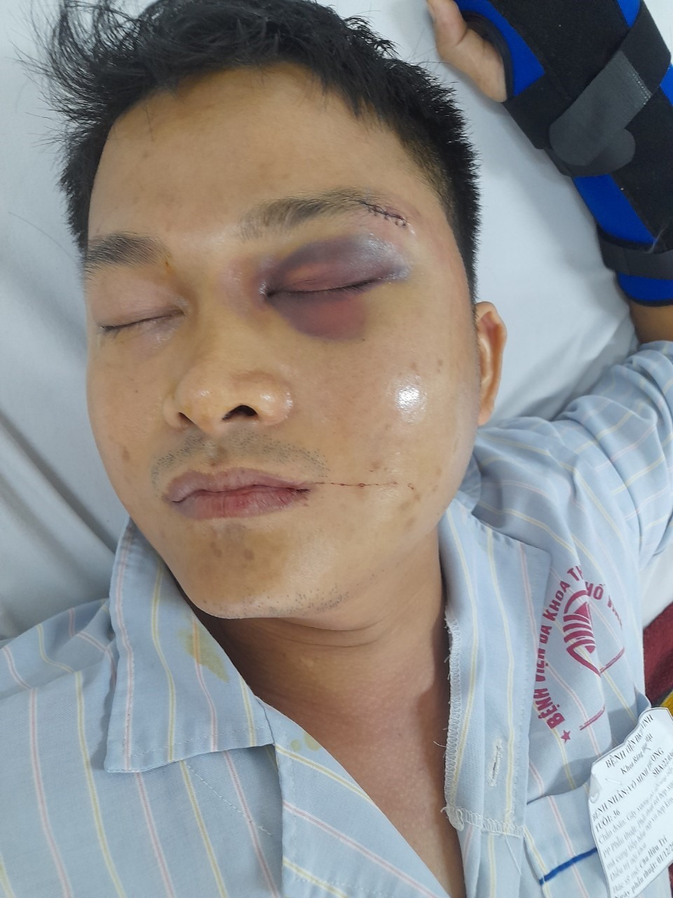 Anh Võ Minh Thương bị đánh đập, gây thương tích 38%. Ảnh: Quang Đại