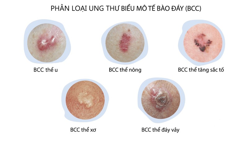 Ung Thư Da Lành Tính: Nguyên Nhân, Triệu Chứng và Phương Pháp Phòng Ngừa Hiệu Quả