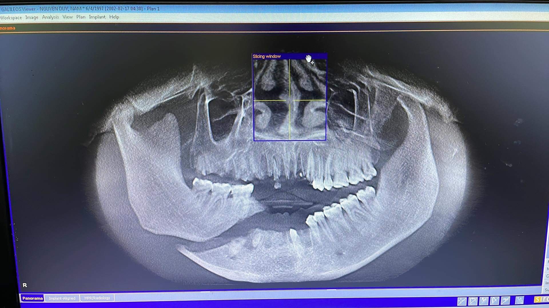 Hình ảnh xương hàm vỡ của thanh niên 32 tuổi sau khi bị tai nạn thang máy trong nhà. Ảnh Bệnh viện cung cấp