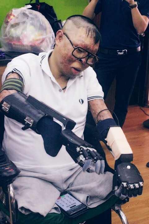 Chiến sĩ Đinh Văn Dương đã có thể cử động và làm một số hoạt động với đôi tay giả.