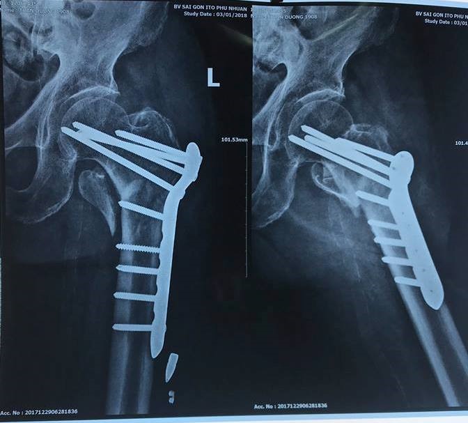 Phẫu thuật thành công bằng phương pháp kết hợp xương bằng nẹp vis cho bệnh nhân