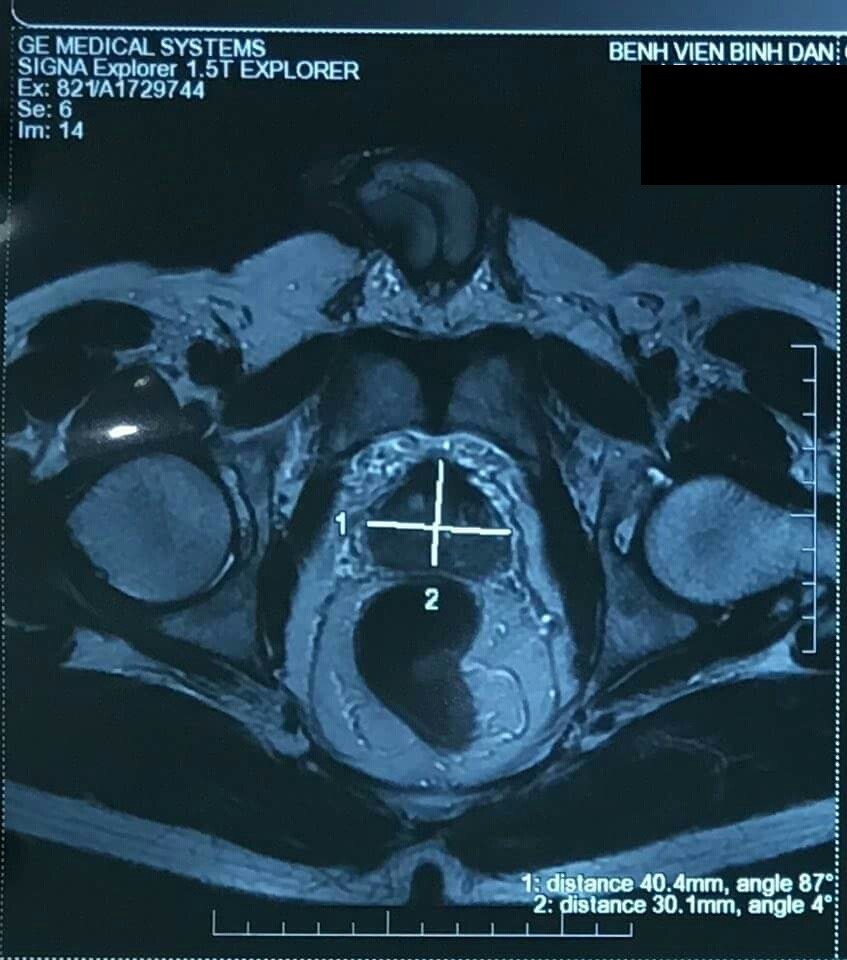 Bướu tuyến tiền liệt của bệnh nhân D. được phẫu thuật robot