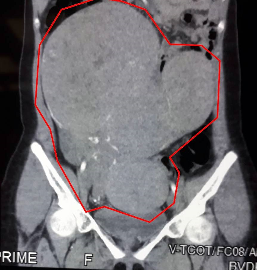 Ảnh chụp CT 160 lát của bệnh nhân có khối u to chiếm trọn ổ bụng