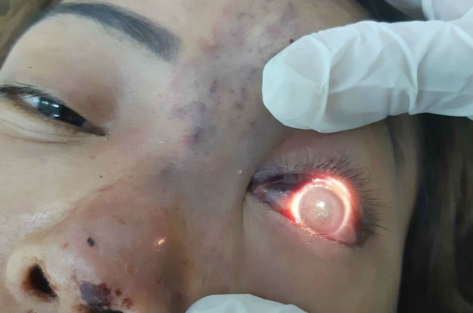 Chị D. bị mù mắt trái khi tiêm filler ở TN - Beauty clinic Spa (Ảnh: Vietnamnet)