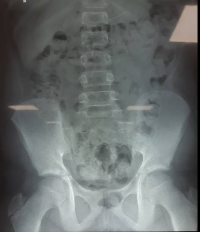 Hình ảnh chụp Xquang của bệnh nhi.