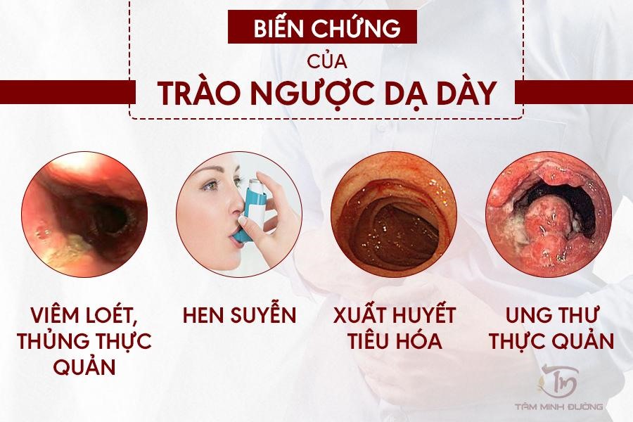 Trị Dứt Điểm Trào Ngược Dạ Dày: Giải Pháp Hiệu Quả Cho Sức Khỏe Của Bạn