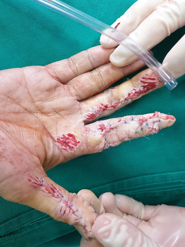 Các ngón tay sau khi được phẫu thuật. Ảnh: benhvienhungvuong.org