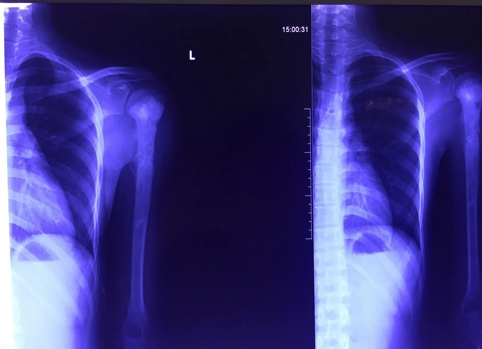 Hình ảnh chụp XQuang cánh tay bệnh nhân L (Ảnh: BVCC)