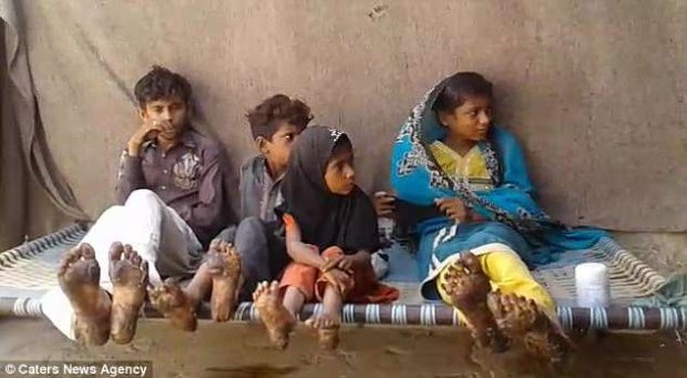 4 đứa con của anh Nazir mắc bệnh tăng sừng ly thượng bì. Ảnh Daily Mail