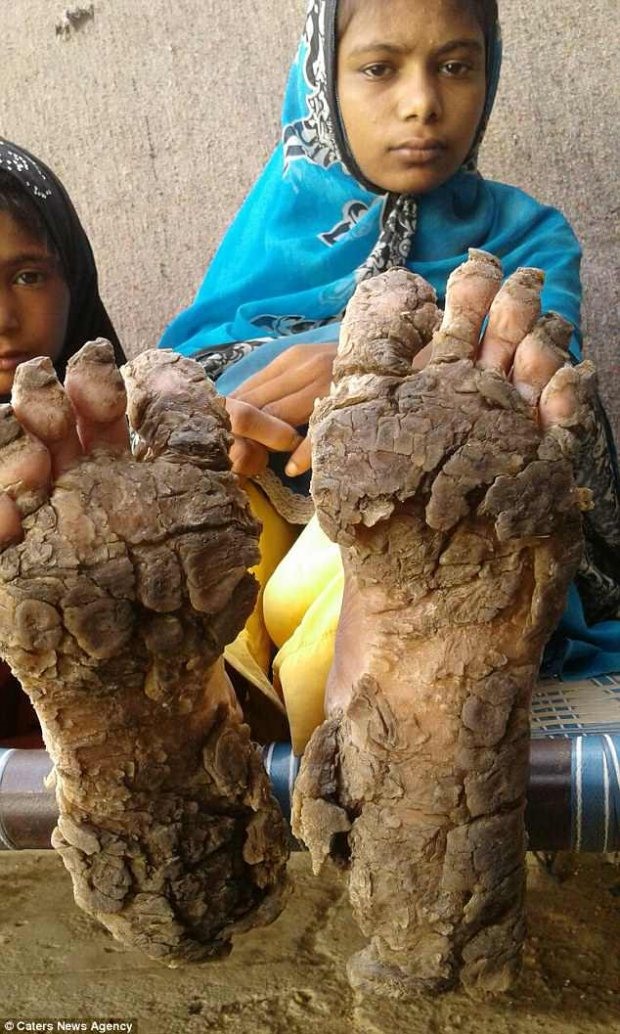 Chân của những đứa trẻ bị cứng như đá, khiến chúng gặp nhiều khó khăn trong việc di chuyển. Ảnh Daily Mail