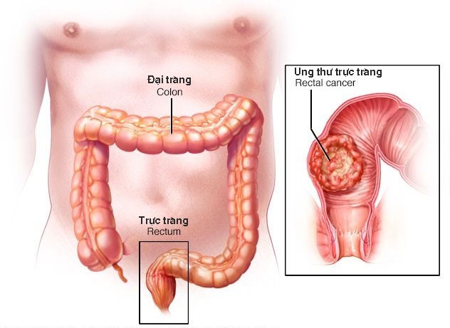 Mô tả ung thư đường tiêu hóa (Ảnh: BSCC)